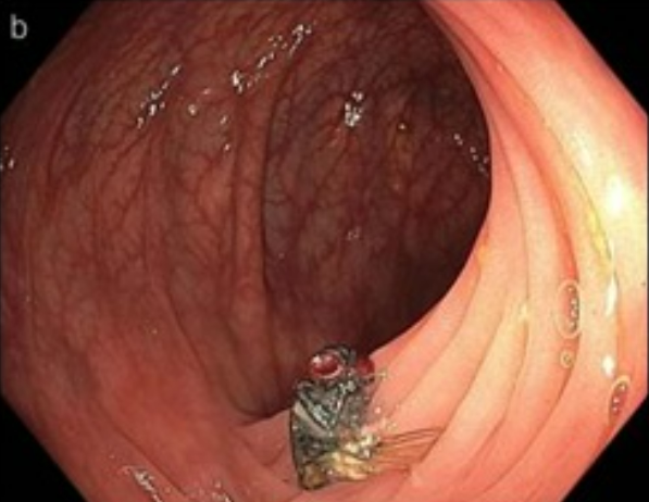 intestines, missouri, colonoscopy, flies, horror as fly found inside missouri man’s intestines